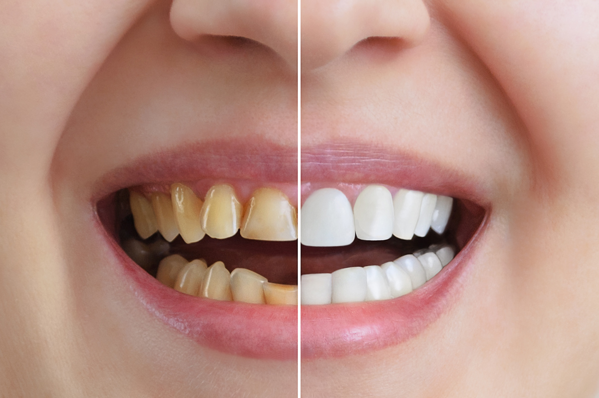 Teeth Whitening showing before and after