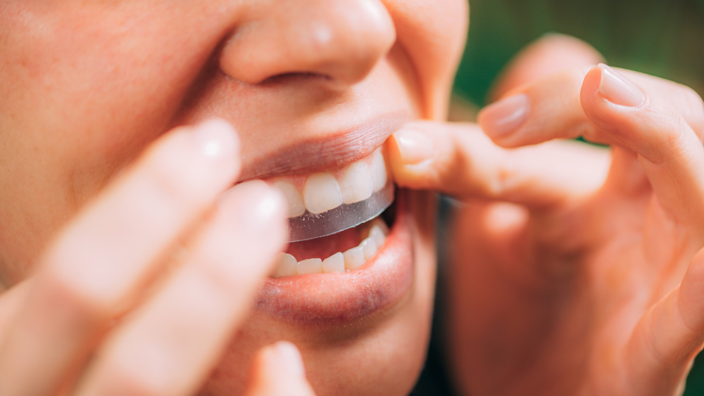 Cosmetic dental-teeth-whitening-strips application