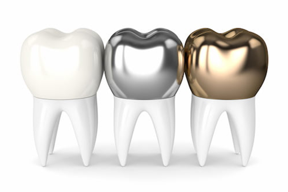 Restorative Dentistry Types of Crowns