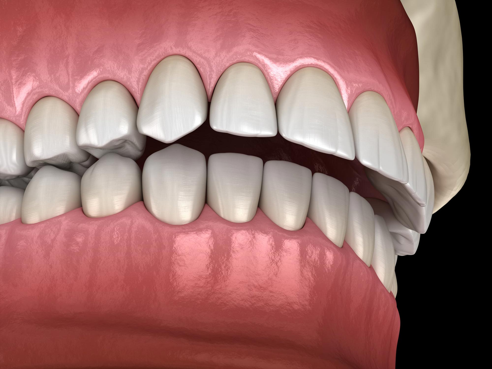 Overbite of teeth