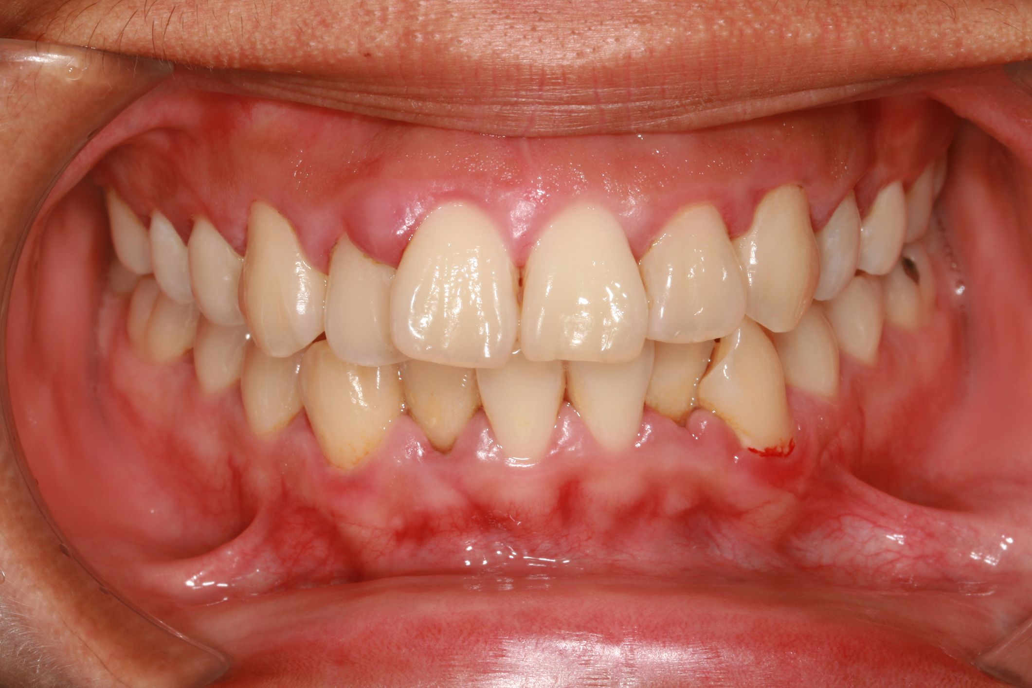 Periodontal disease showing the gum disease