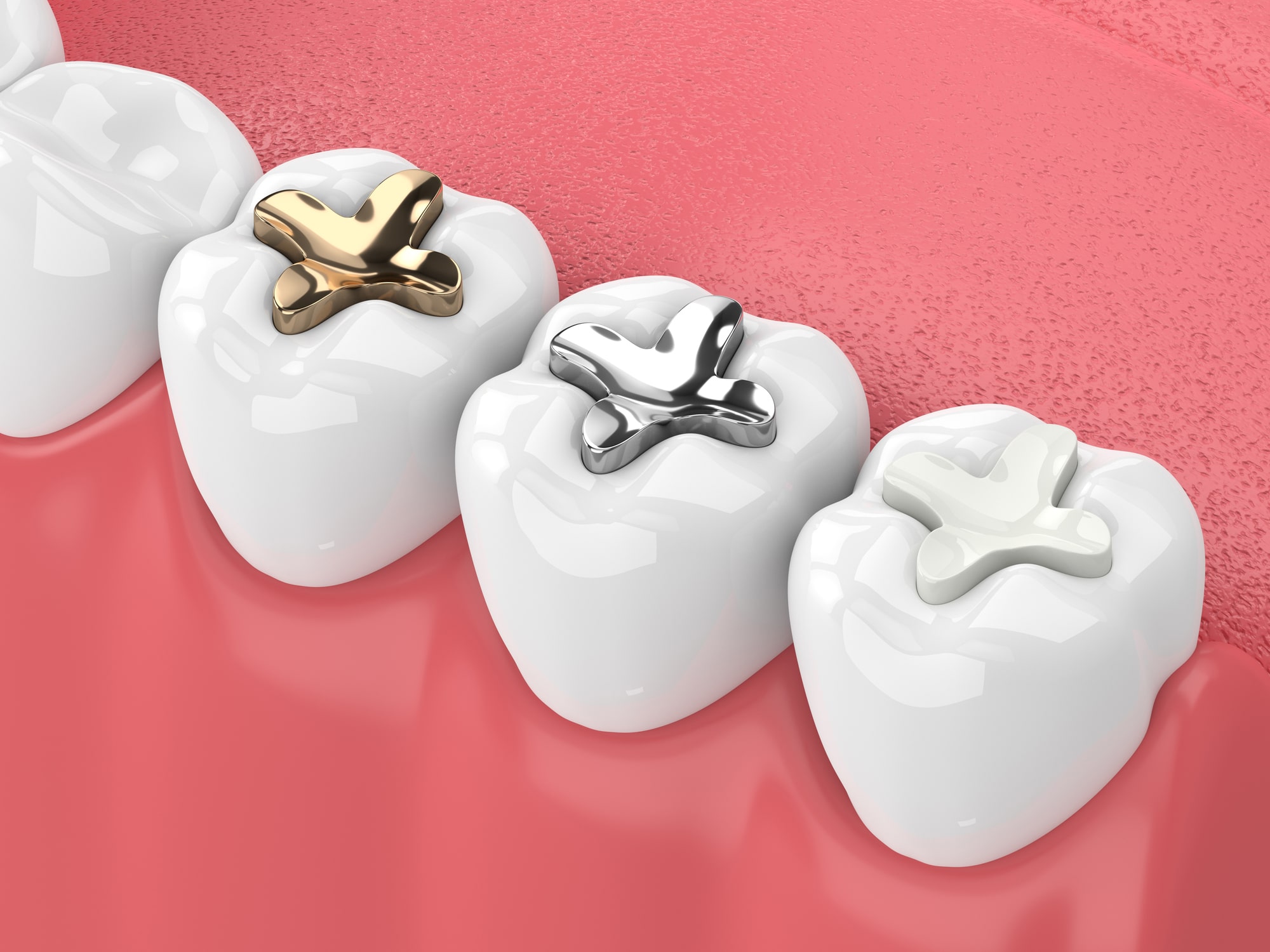 Restorative Dentistry Filling Types