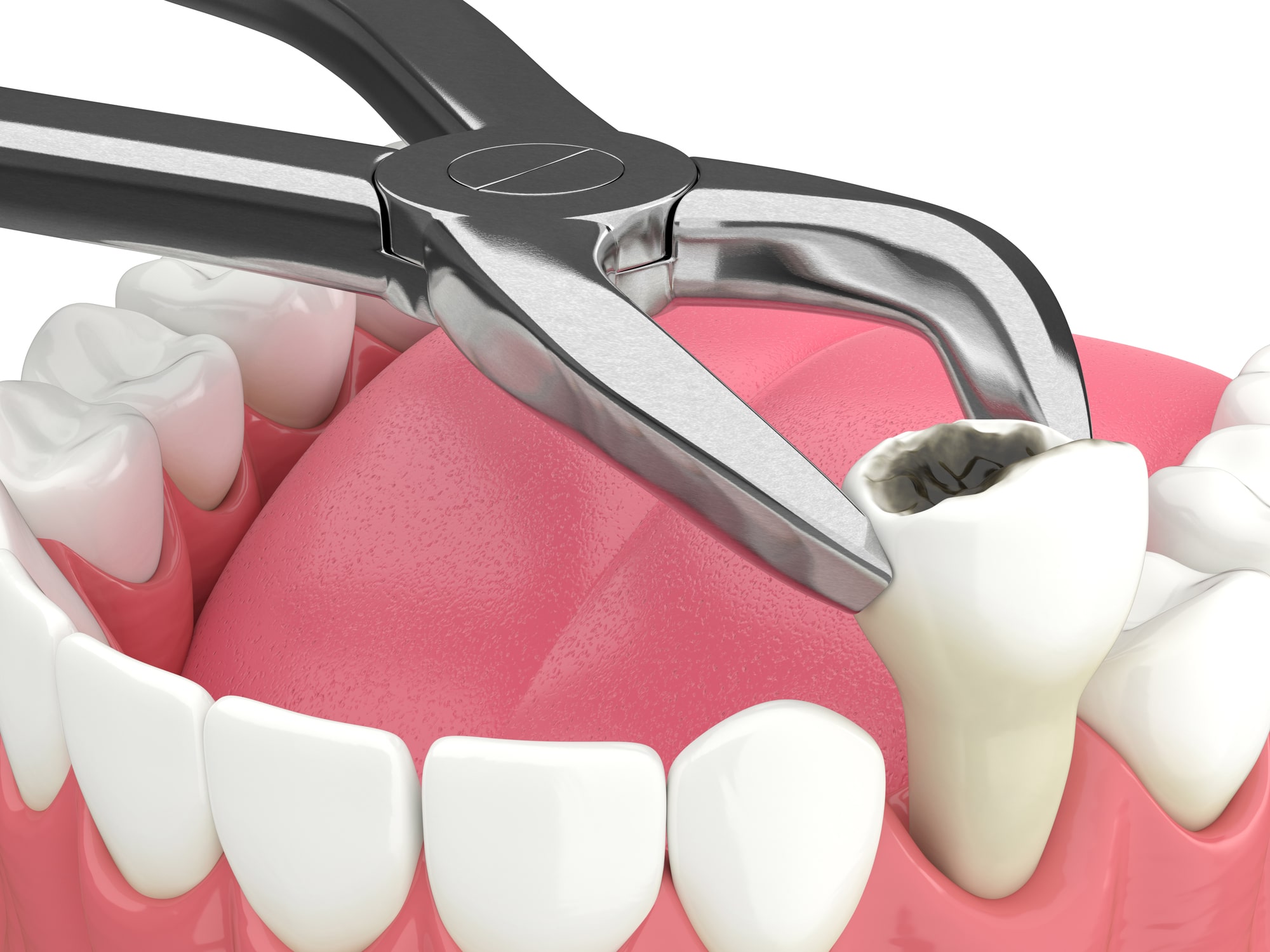 Restorative Dentistry Tooth Extraction Cavity