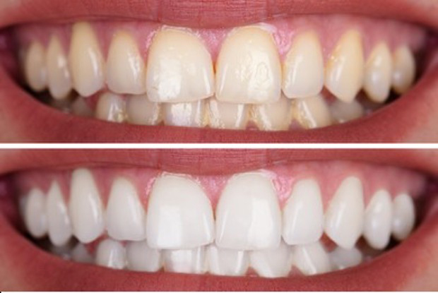 whiter teeth bright smiles whitening