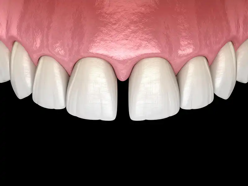 Diastema close-up of teeth