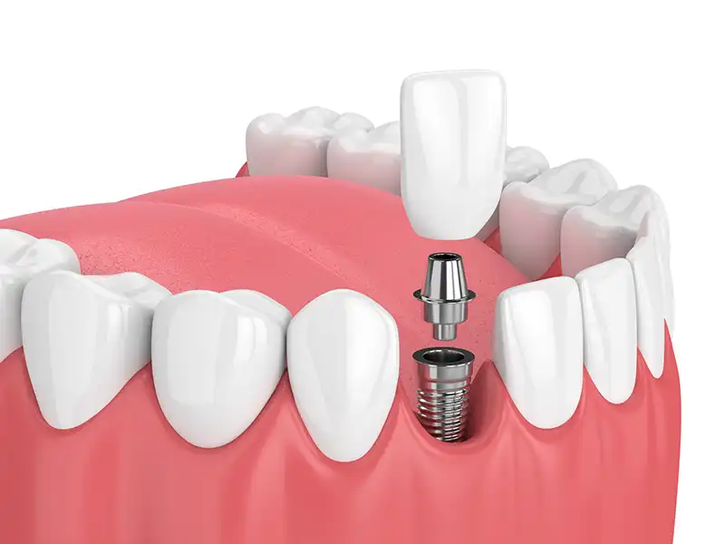 Dental Implants show the insertion process