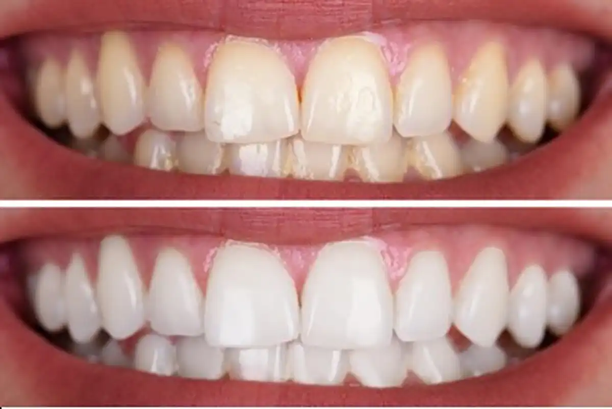 whiter teeth bright smiles whitening