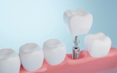 Dental Implants vs. Bridges: Choosing the Best Option for Your Smile
