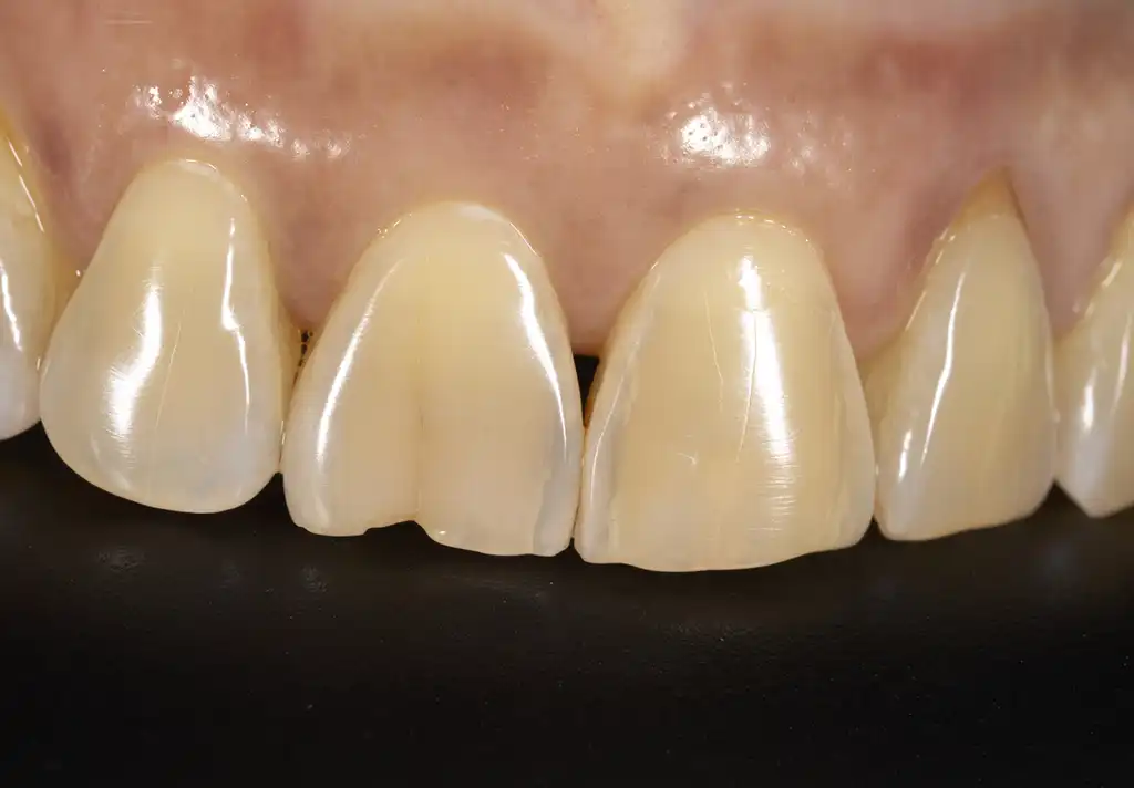 Parr Dental Worn teeth